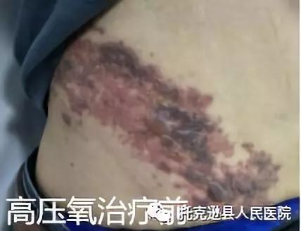 警示故事，拆快递后揉眼引发眼部带状疱疹