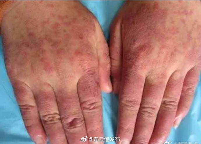 红斑狼疮揭秘，为何被称为不死的癌症？