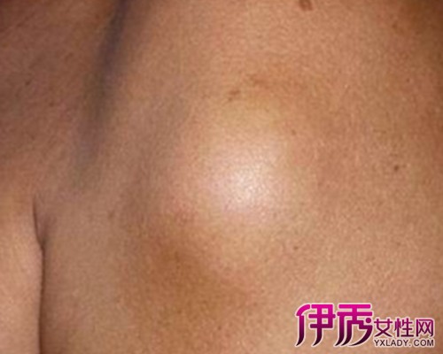 脂肪瘤最新治疗方法,脂肪瘤最新治疗方法的奇妙之旅